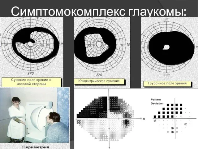 Симптомокомплекс глаукомы: