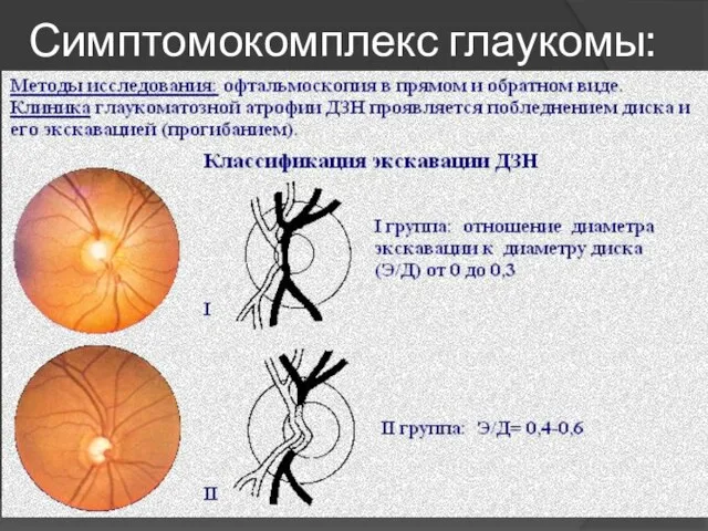 Симптомокомплекс глаукомы: