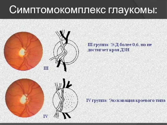 Симптомокомплекс глаукомы: