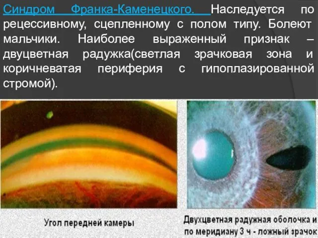 Синдром Франка-Каменецкого. Наследуется по рецессивному, сцепленному с полом типу. Болеют мальчики.