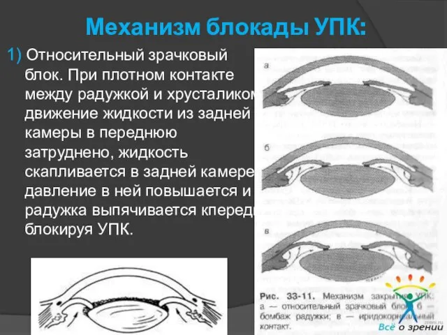 1) Относительный зрачковый блок. При плотном контакте между радужкой и хрусталиком