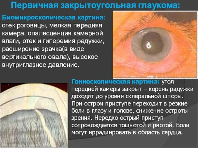 Первичная закрытоугольная глаукома: Биомикроскопическая картина: отек роговицы, мелкая передняя камера, опалесценция