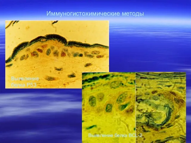 Иммуногистохимические методы Выявление белка Р53 Выявление белка BCL-2