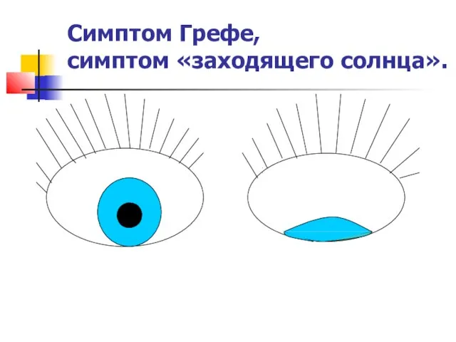 Симптом Грефе, симптом «заходящего солнца».