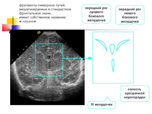 передний рог левого бокового желудочка полость прозрачной перегородки III желудочек передний