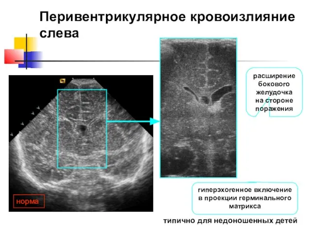 Перивентрикулярное кровоизлияние слева норма типично для недоношенных детей гиперэхогенное включение в