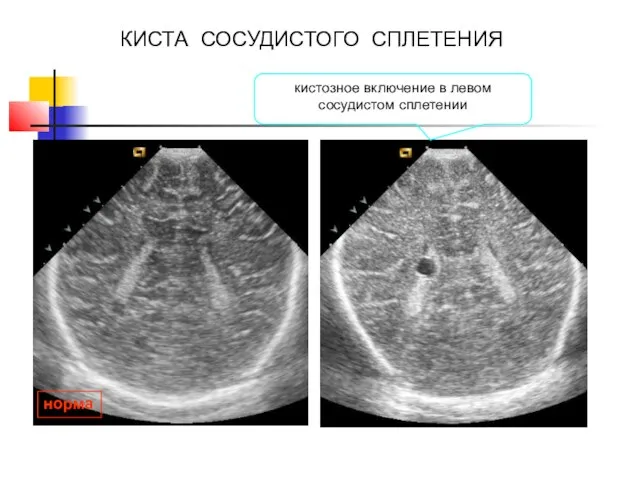 норма КИСТА СОСУДИСТОГО СПЛЕТЕНИЯ кистозное включение в левом сосудистом сплетении