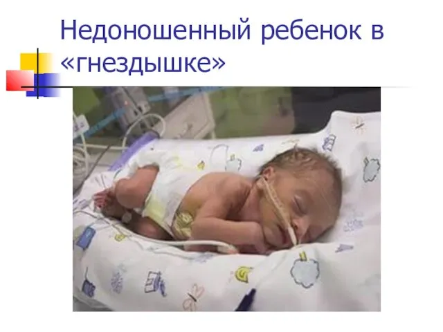 Недоношенный ребенок в «гнездышке»