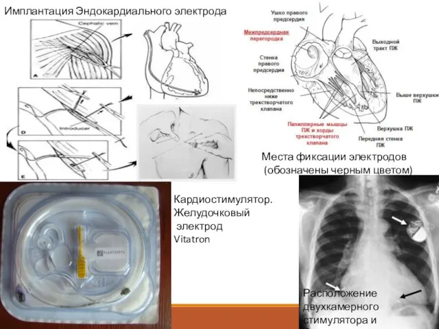 Места фиксации электродов (обозначены черным цветом) Имплантация Эндокардиального электрода Расположение двухкамерного