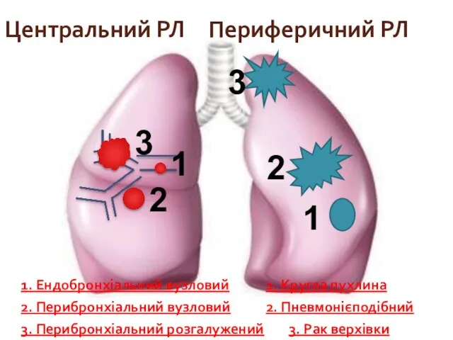 Центральний РЛ Периферичний РЛ 1. Ендобронхіальний вузловий 1. Кругла пухлина 2.