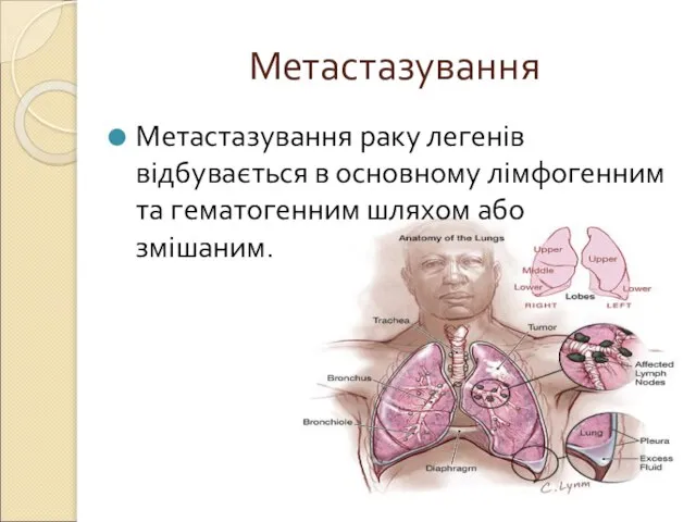 Метастазування Метастазування раку легенів відбувається в основному лімфогенним та гематогенним шляхом або змішаним.