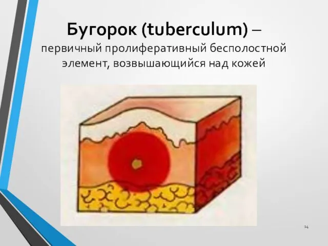 Бугорок (tuberculum) – первичный пролиферативный бесполостной элемент, возвышающийся над кожей