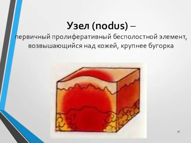 Узел (nodus) – первичный пролиферативный бесполостной элемент, возвышающийся над кожей, крупнее бугорка