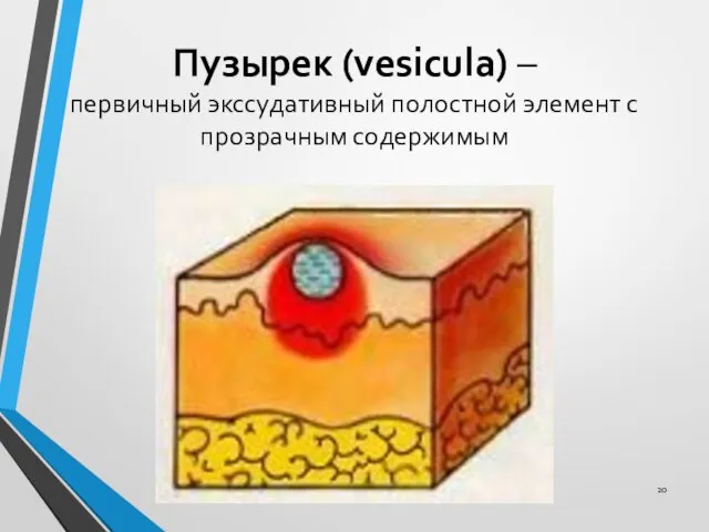 Пузырек (vesicula) – первичный экссудативный полостной элемент с прозрачным содержимым