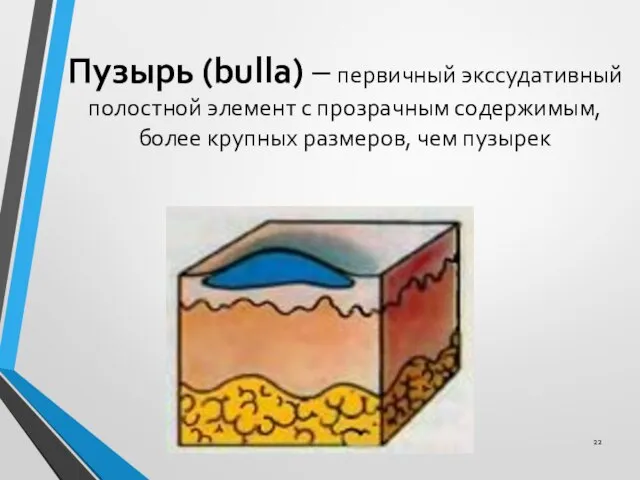 Пузырь (bulla) – первичный экссудативный полостной элемент с прозрачным содержимым, более крупных размеров, чем пузырек