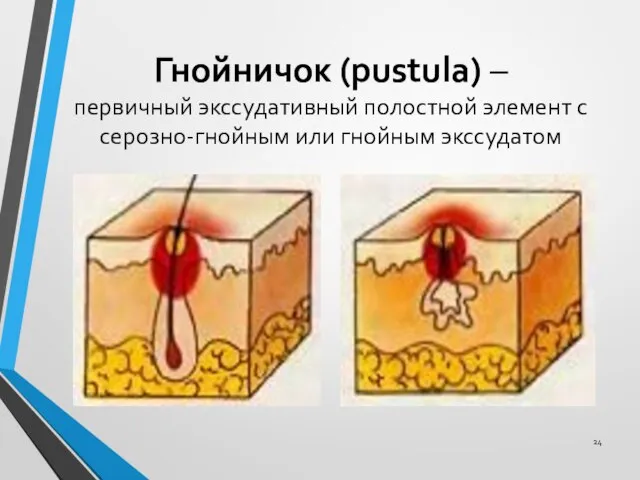 Гнойничок (pustula) – первичный экссудативный полостной элемент с серозно-гнойным или гнойным экссудатом