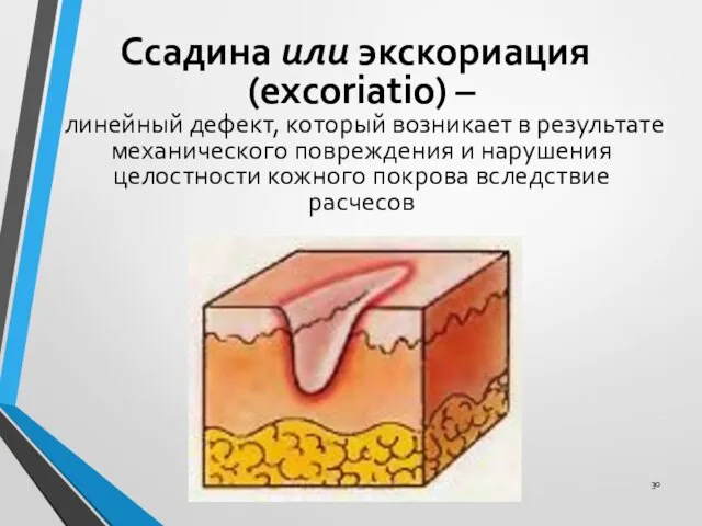 Ссадина или экскориация (excoriatio) – линейный дефект, который возникает в результате