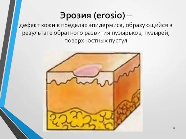 Эрозия (erosio) – дефект кожи в пределах эпидермиса, образующийся в результате