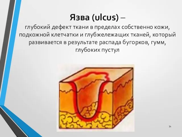 Язва (ulcus) – глубокий дефект ткани в пределах собственно кожи, подкожной