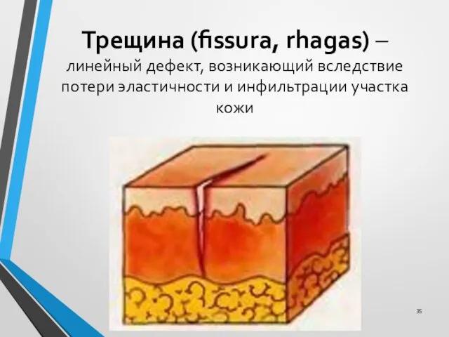 Трещина (fissura, rhagas) – линейный дефект, возникающий вследствие потери эластичности и инфильтрации участка кожи