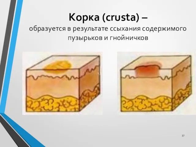 Корка (crusta) – образуется в результате ссыхания содержимого пузырьков и гнойничков