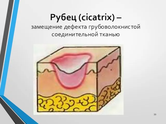 Рубец (cicatrix) – замещение дефекта грубоволокнистой соединительной тканью