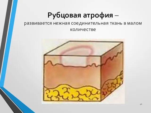 Рубцовая атрофия – развивается нежная соединительная ткань в малом количестве