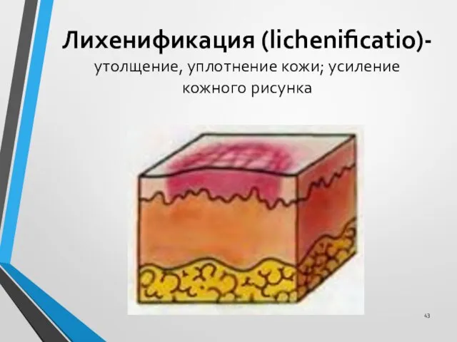 Лихенификация (lichenificatio)- утолщение, уплотнение кожи; усиление кожного рисунка