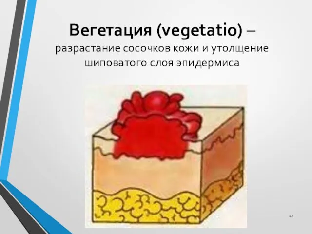 Вегетация (vegetatio) – разрастание сосочков кожи и утолщение шиповатого слоя эпидермиса