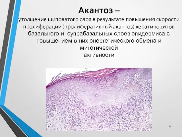 Акантоз – утолщение шиповатого слоя в результате повышения скорости пролиферации (пролиферативный