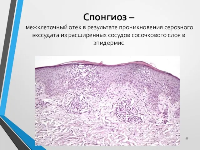 Спонгиоз – межклеточный отек в результате проникновения серозного экссудата из расширенных сосудов сосочкового слоя в эпидермис