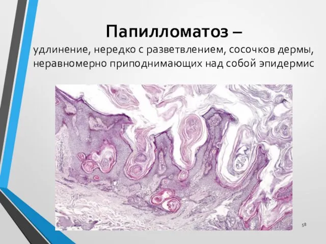 Папилломатоз – удлинение, нередко с разветвлением, сосочков дермы, неравномерно приподнимающих над собой эпидермис