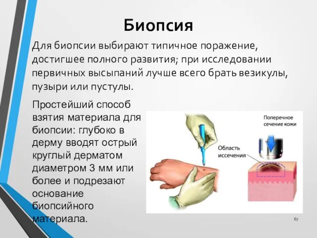 Для биопсии выбирают типичное поражение, достигшее полного развития; при исследовании первичных