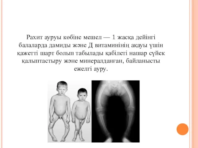 Рахит ауруы көбіне мешел — 1 жасқа дейінгі балаларда дамиды және