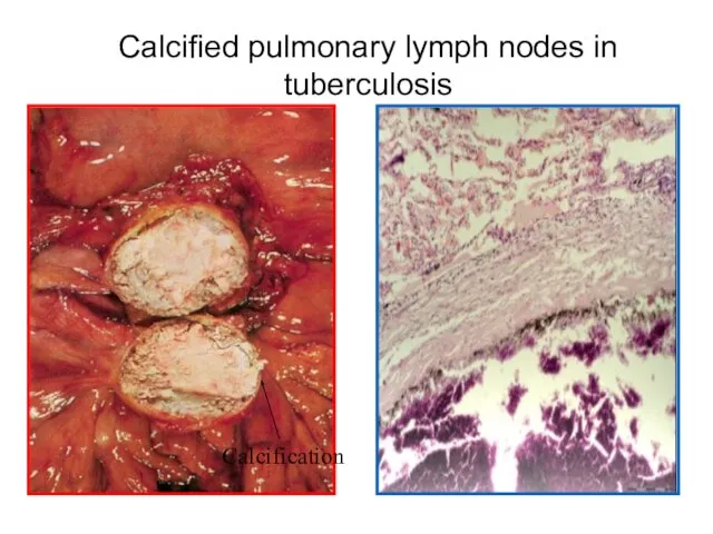 Calcified pulmonary lymph nodes in tuberculosis Calcification