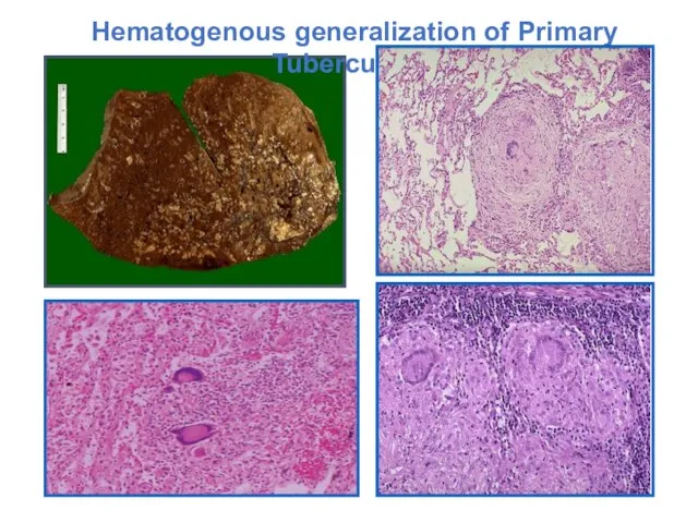 Hematogenous generalization of Primary Tuberculosis