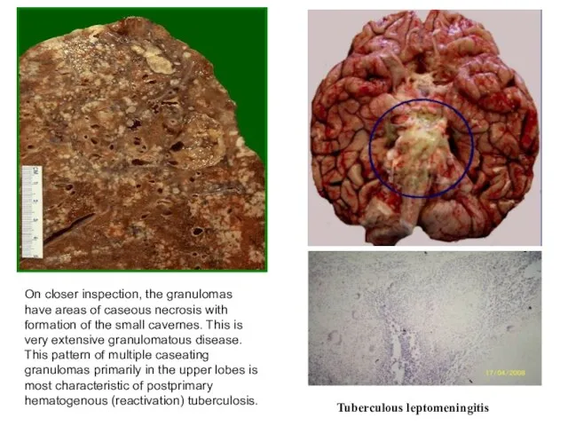 On closer inspection, the granulomas have areas of caseous necrosis with