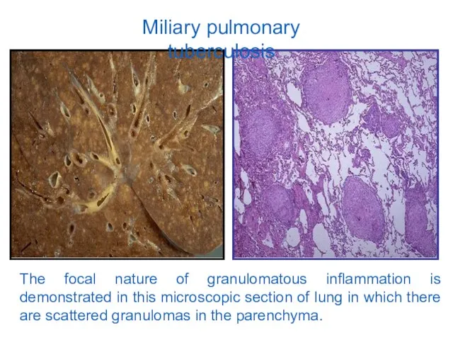 Miliary pulmonary tuberculosis The focal nature of granulomatous inflammation is demonstrated