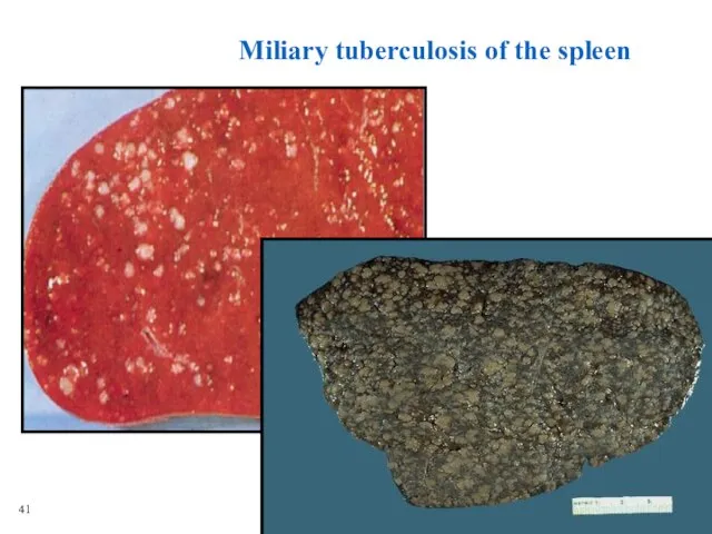 Miliary tuberculosis of the spleen 41