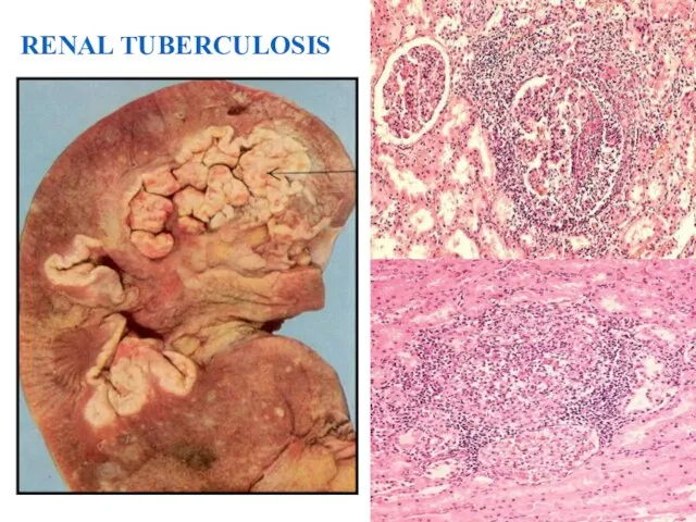 RENAL TUBERCULOSIS 39