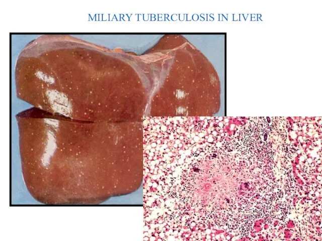 MILIARY TUBERCULOSIS IN LIVER 40