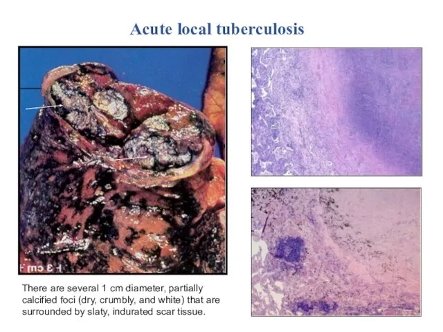 Acute local tuberculosis There are several 1 cm diameter, partially calcified