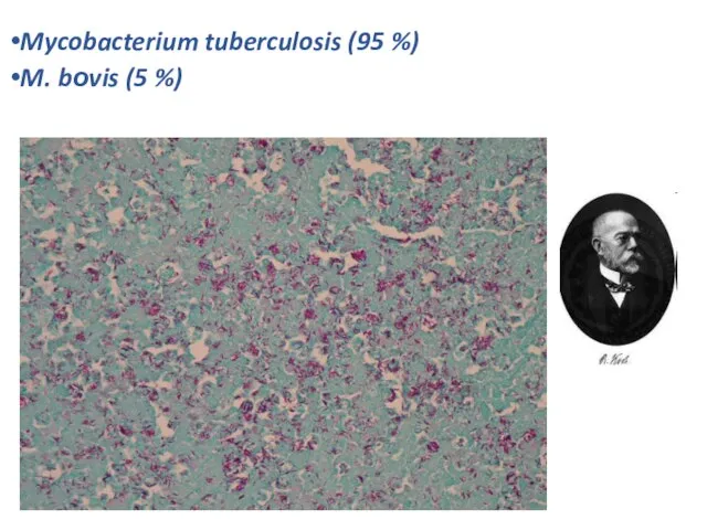 Mycobacterium tuberculosis (95 %) M. bоvis (5 %)