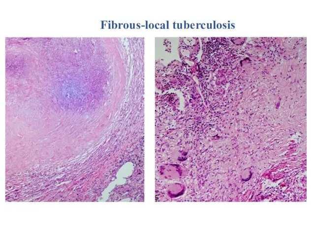 Fibrous-local tuberculosis