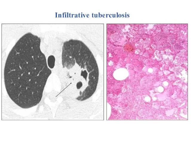 Infiltrative tuberculosis