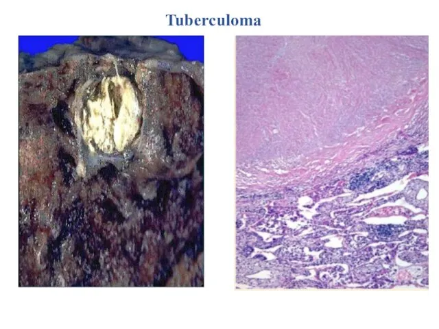 Tuberculoma