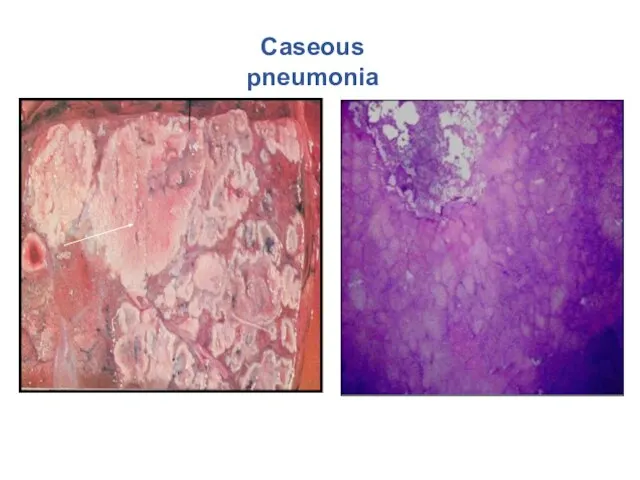 Caseous pneumonia