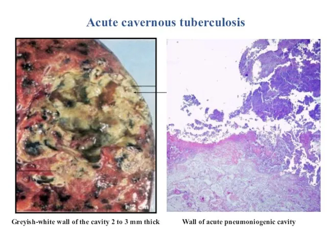 Greyish-white wall of the cavity 2 to 3 mm thick Acute