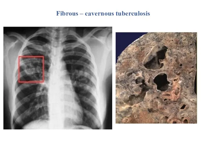 Fibrous – cavernous tuberculosis