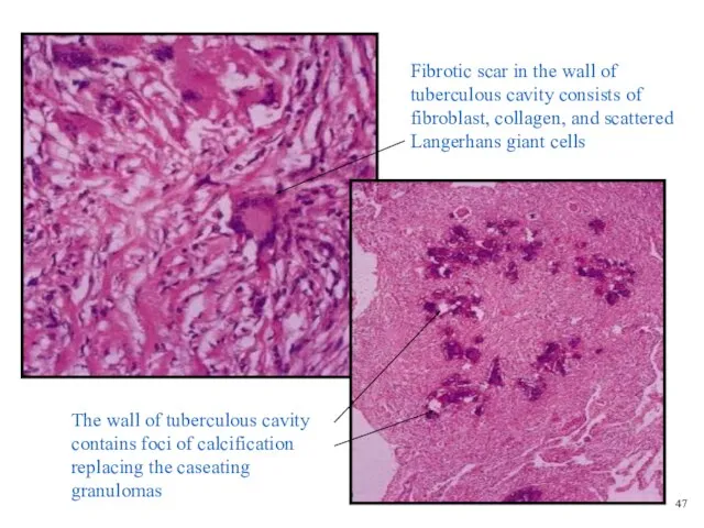 Fibrotic scar in the wall of tuberculous cavity consists of fibroblast,